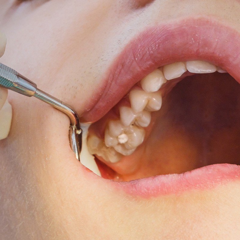 Restorative Fillings